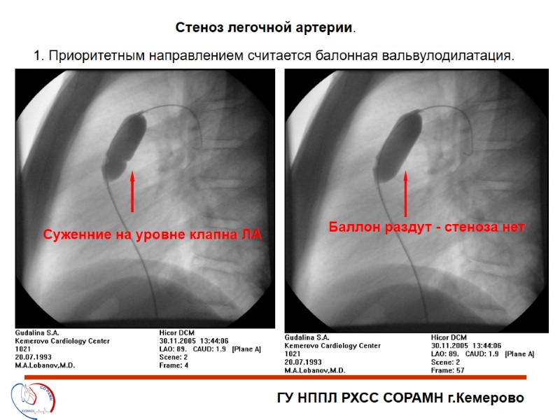 ГУ НППЛ РХСС СОРАМН г.Кемерово Стеноз легочной артерии. 1. Приоритетным направлением считается балонная вальвулодилатация.